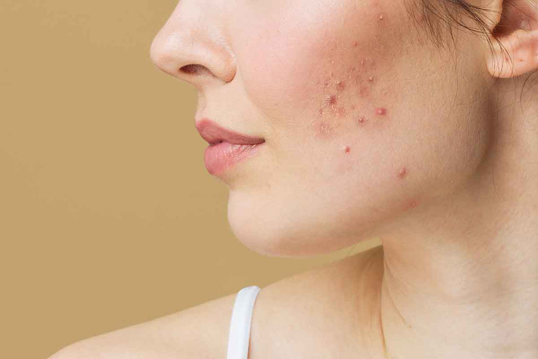 Best Acne Cream In Pakistan: A Guide For Your Acne Prone Skin